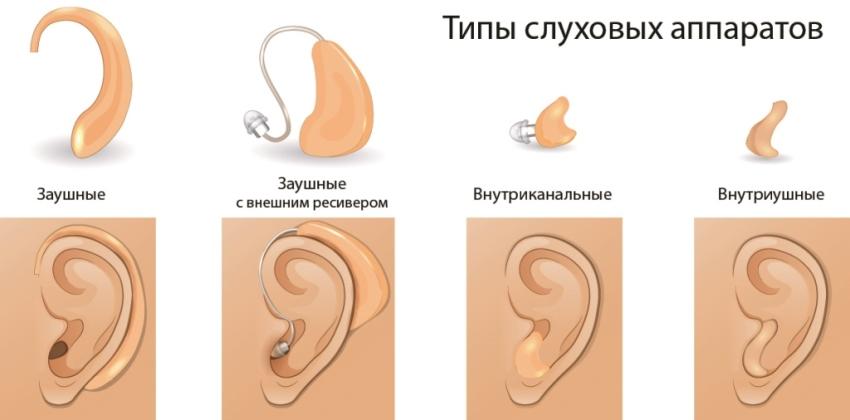 Какие есть типы слуховых аппаратов